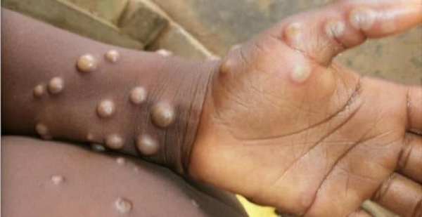 Madagascar va mettre en place le processus de diagnostiquer la variole du singe