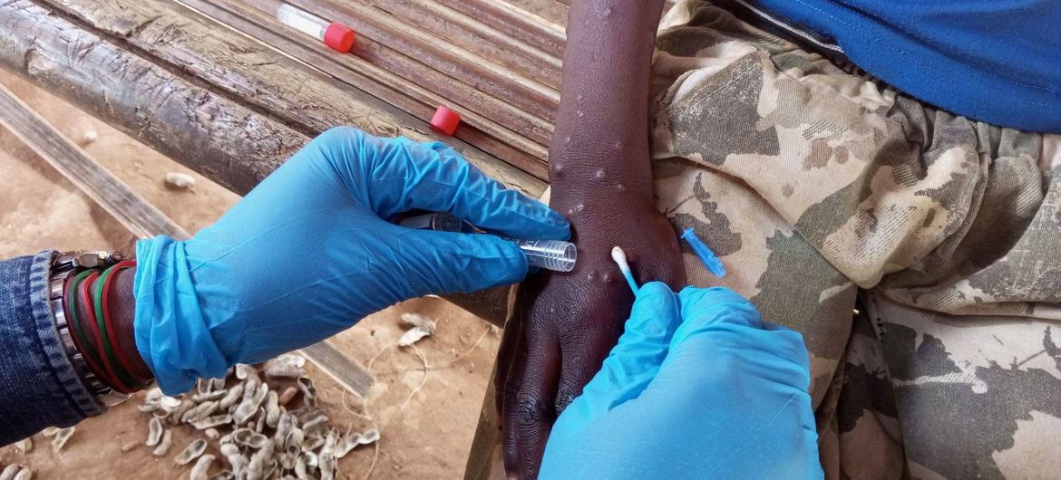 La Guinée-Conakry signale le recensement de 18 cas officiels de Mpox